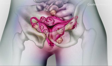 10 Herbal Remedies For Fibroids And Cysts You Need To Know