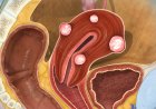 CAUSES  OF  FIBRIOD  RECURRENCE  AND HOW HERBAL REMEDIES CAN  HELP