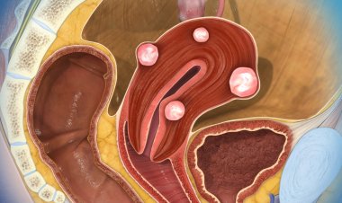 CAUSES  OF  FIBRIOD  RECURRENCE  AND HOW HERBAL REMEDIES CAN  HELP